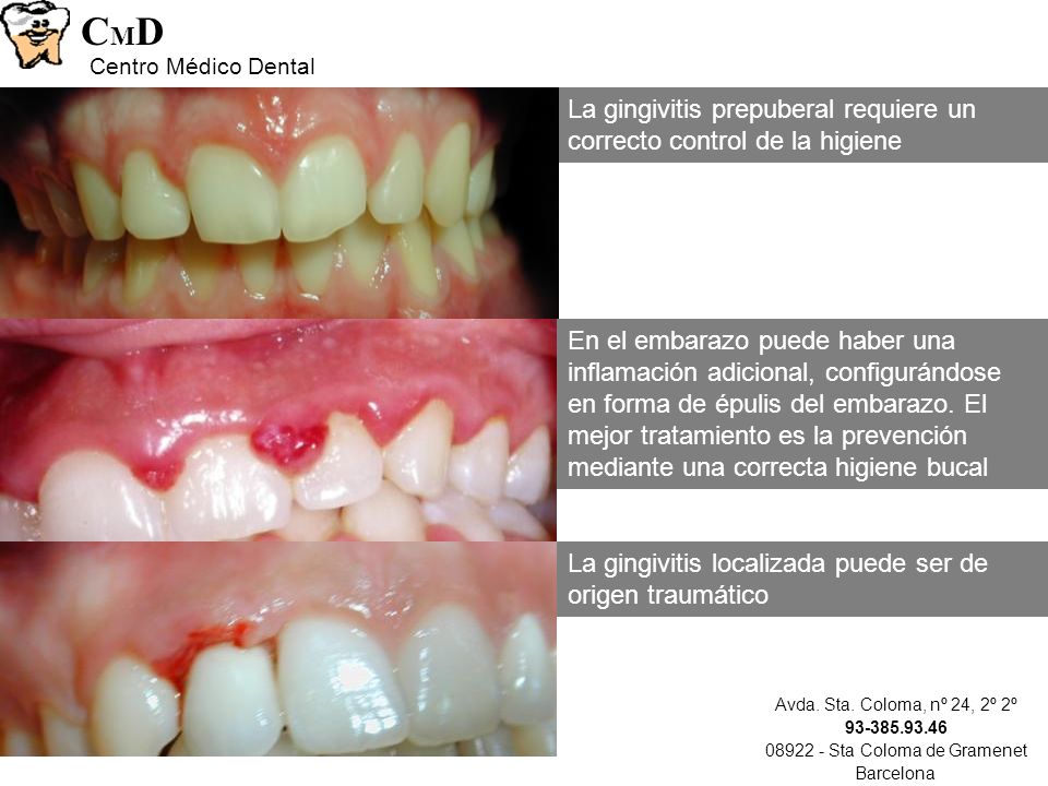 Tratamiento para la gingivitis bucal